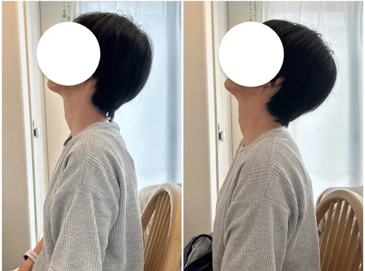 ストレートネックに